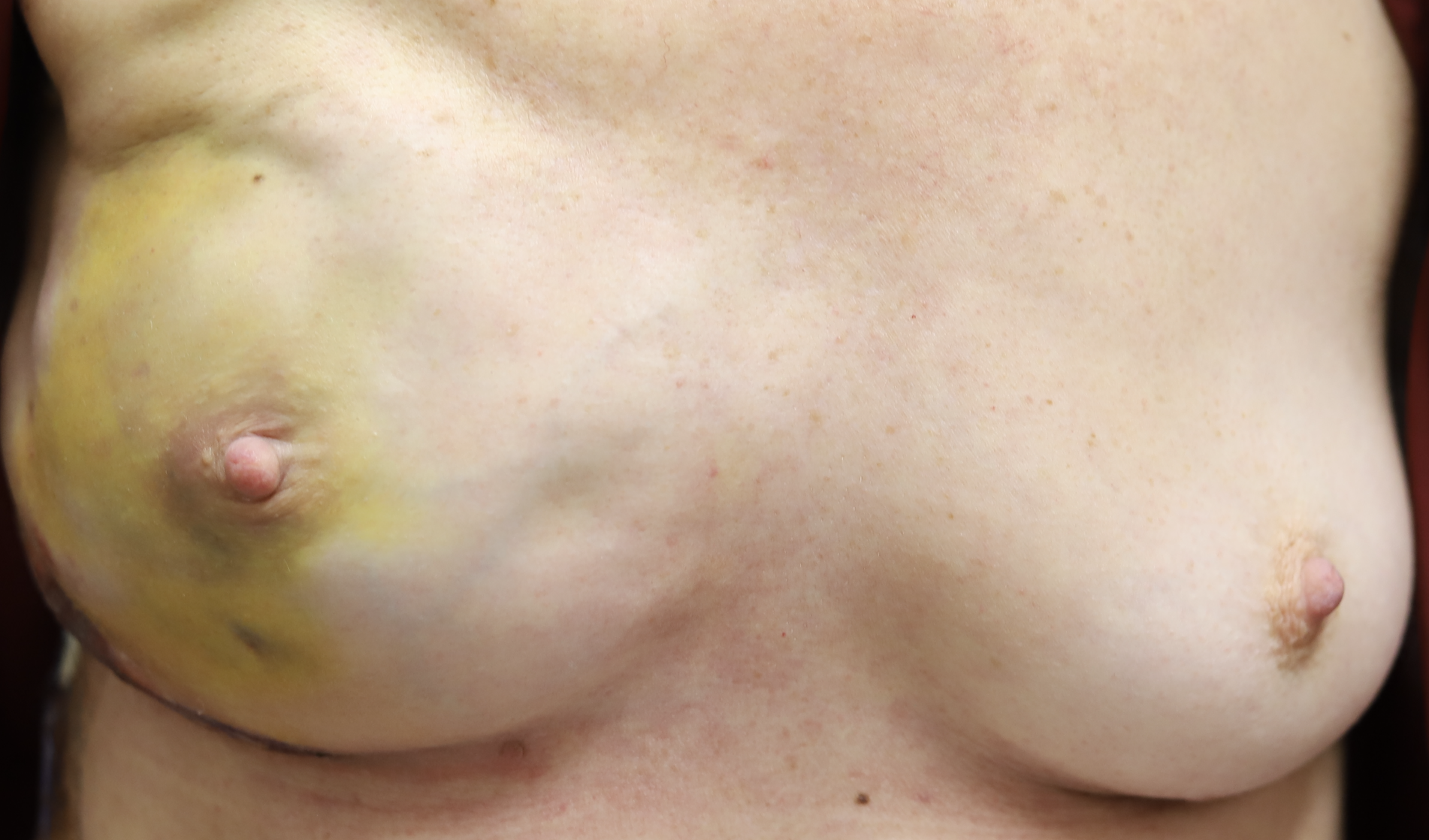 Right nipple sparing mastectomy and tissue expander placement.